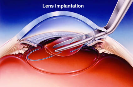 Heerlijk kooi vrek Can Laser Vision Correction Help After Cataract Surgery? - Acuity Laser Eye  & Vision Center