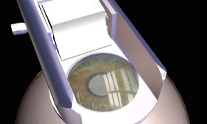 EPI-LASIK image showing the eye