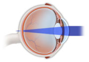 Hyperopia in the eye diagram